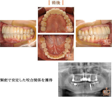 術後