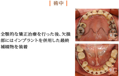 術中