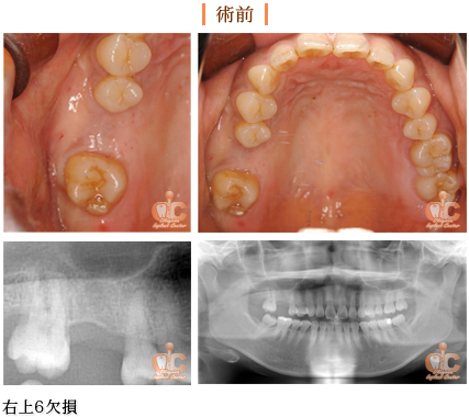 術前