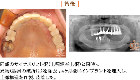 術後