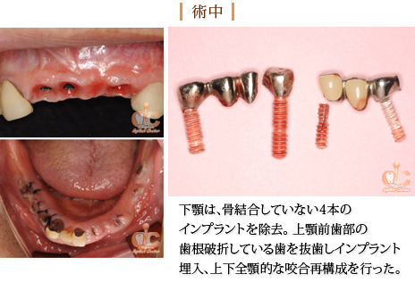 術中