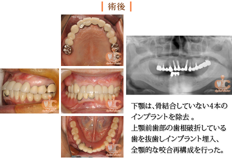 術後